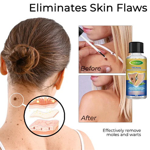 Fivfivgo® TAGAway Moles & Warts Removal Solution