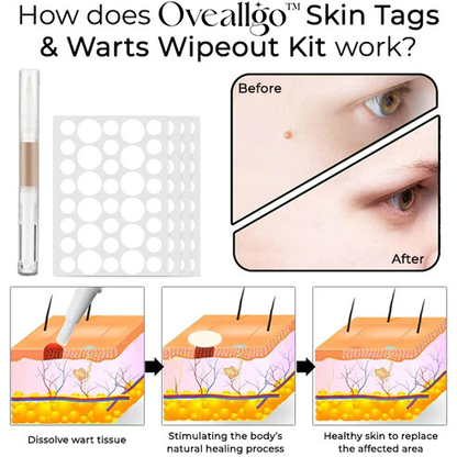 Oveallgo™ Skin Tags & Warts Wipeout Kit