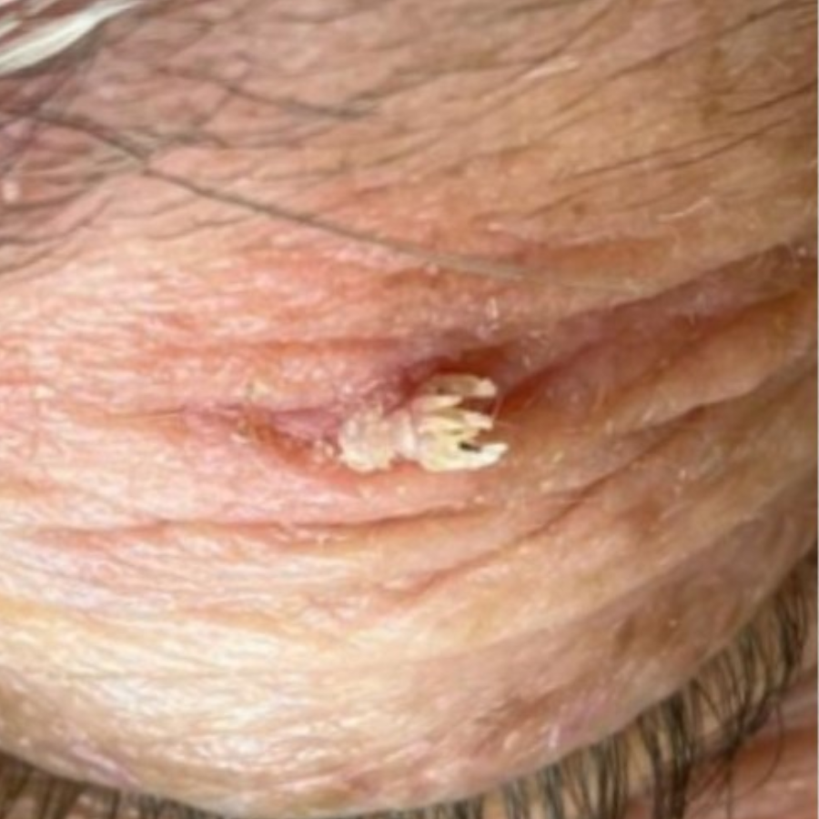 Fivfivgo® HPV Facial Filiform Warts Removal Cream 25 Fivfivgo® HPV Facial Filiform Warts Removal Cream