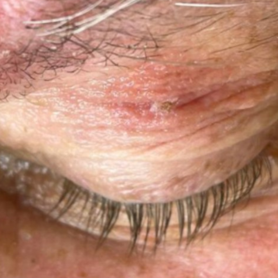 Fivfivgo® HPV Facial Filiform Warts Removal Cream 26 Fivfivgo® HPV Facial Filiform Warts Removal Cream