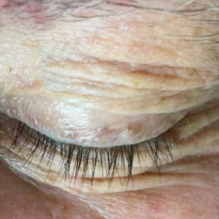 Fivfivgo® HPV Facial Filiform Warts Removal Cream 27 Fivfivgo® HPV Facial Filiform Warts Removal Cream