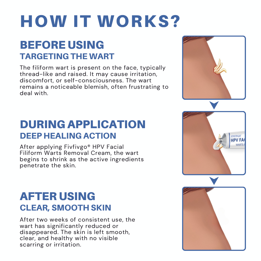 Fivfivgo® HPV Facial Filiform Warts Removal Cream 18 Fivfivgo® HPV Facial Filiform Warts Removal Cream