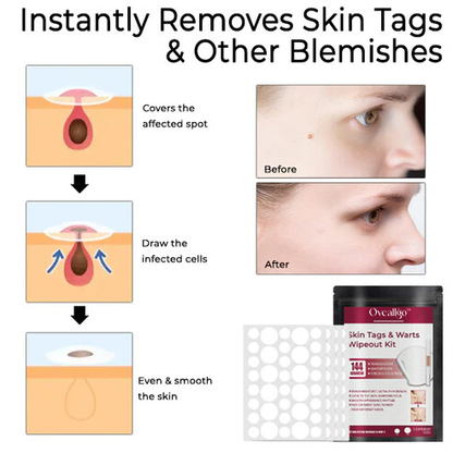 Oveallgo™ Skin Tags & Warts Wipeout Kit