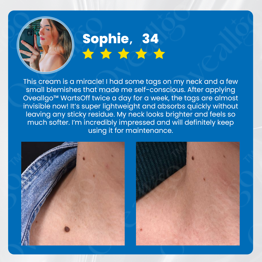 🔷 Official Store: Oveallgo™ WartsOff Instant Blemish Removal Cream👩‍⚕️The Australasian College of Dermatologists (ACD) Approved (Skin Tags, Warts, Dark Spots Removal)