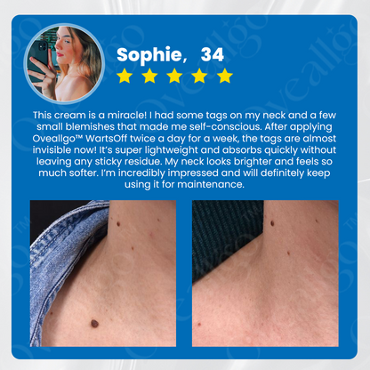 🔷 Official Store: Oveallgo™ WartsOff Instant Blemish Removal Cream👩‍⚕️The Australasian College of Dermatologists (ACD) Approved (Skin Tags, Warts, Dark Spots Removal)