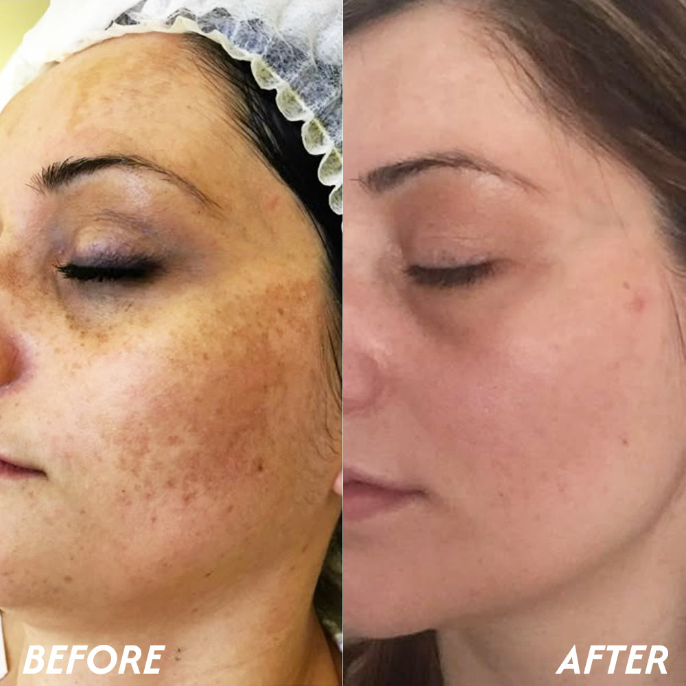 Oveallgo® Korean HerbErase Reedle Shot 100 Black Cumin Seed Oil Dark Spot Corrector Serum 13 Oveallgo® Korean HerbErase Reedle Shot 100 Black Cumin Seed Oil Dark Spot Corrector Serum