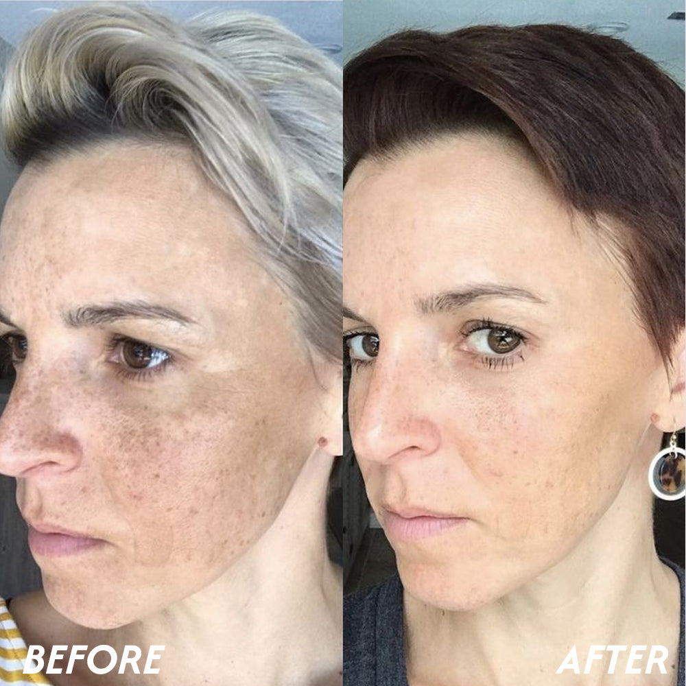 Oveallgo® Korean HerbErase Reedle Shot 100 Black Cumin Seed Oil Dark Spot Corrector Serum 14 Oveallgo® Korean HerbErase Reedle Shot 100 Black Cumin Seed Oil Dark Spot Corrector Serum