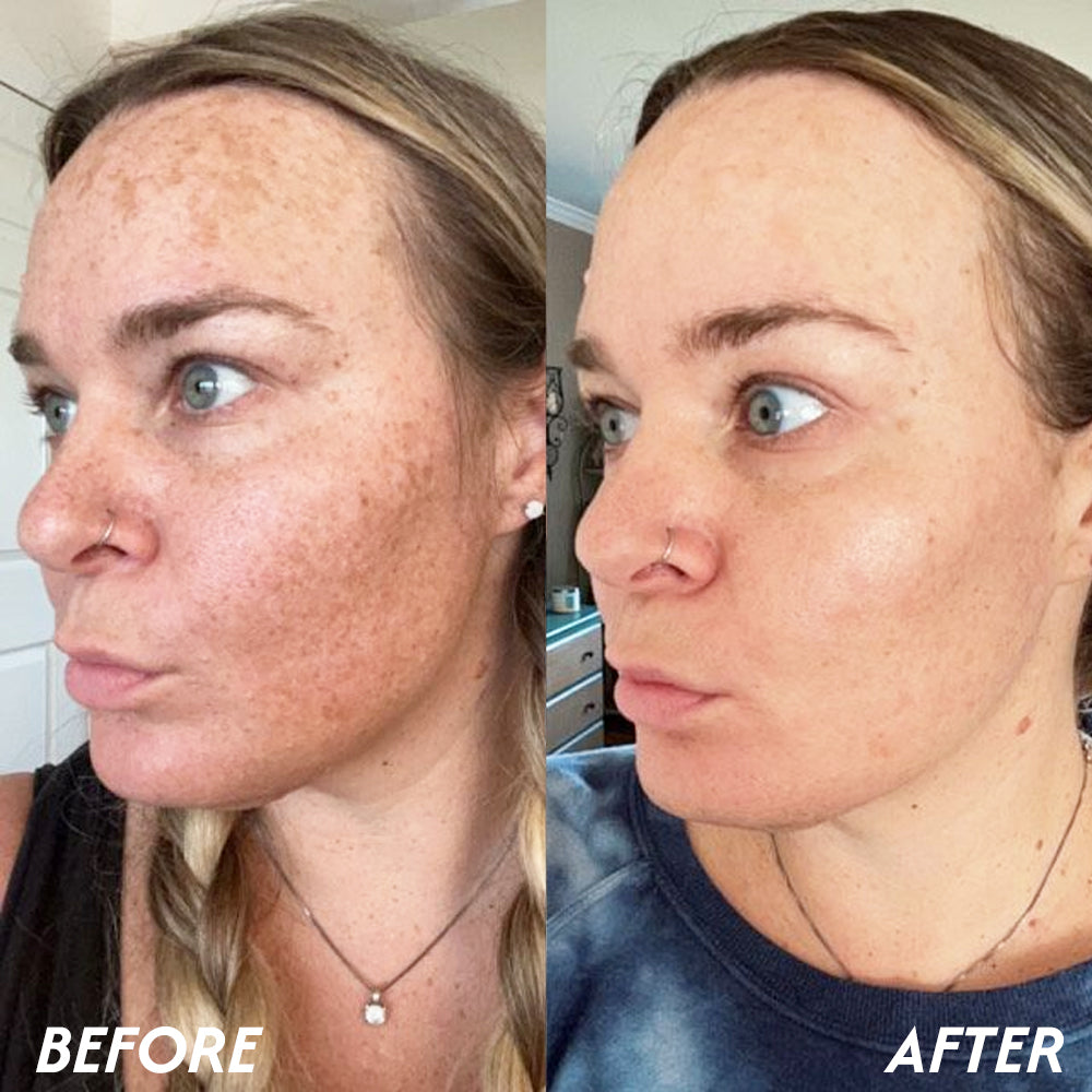 Oveallgo® Korean HerbErase Reedle Shot 100 Black Cumin Seed Oil Dark Spot Corrector Serum 11 Oveallgo® Korean HerbErase Reedle Shot 100 Black Cumin Seed Oil Dark Spot Corrector Serum