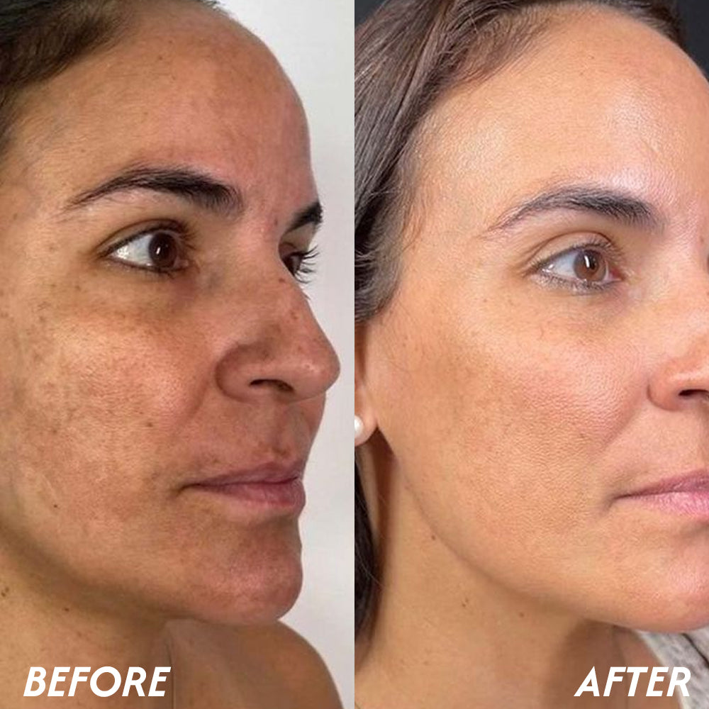 Oveallgo® Korean HerbErase Reedle Shot 100 Black Cumin Seed Oil Dark Spot Corrector Serum 12 Oveallgo® Korean HerbErase Reedle Shot 100 Black Cumin Seed Oil Dark Spot Corrector Serum