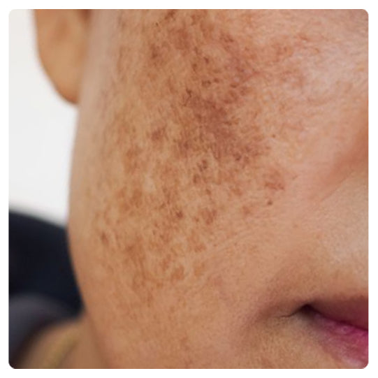 Oveallgo® Korean HerbErase Reedle Shot 100 Black Cumin Seed Oil Dark Spot Corrector Serum 20 Oveallgo® Korean HerbErase Reedle Shot 100 Black Cumin Seed Oil Dark Spot Corrector Serum