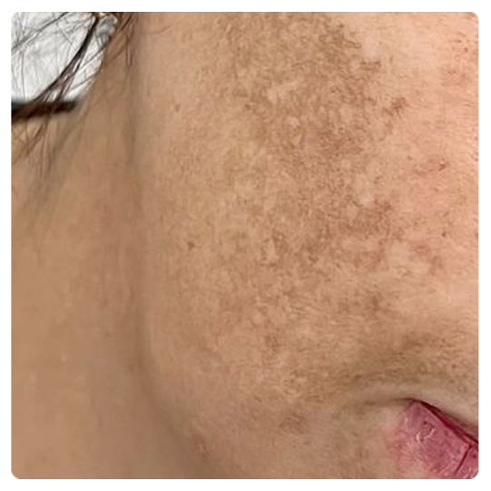 Oveallgo® Korean HerbErase Reedle Shot 100 Black Cumin Seed Oil Dark Spot Corrector Serum 21 Oveallgo® Korean HerbErase Reedle Shot 100 Black Cumin Seed Oil Dark Spot Corrector Serum