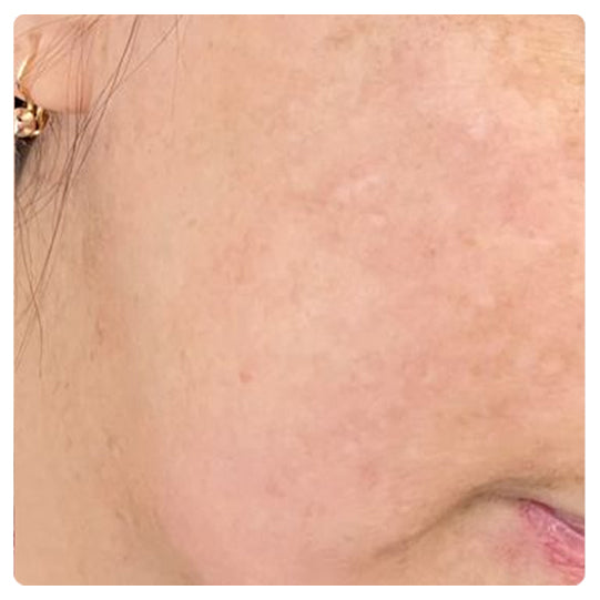 Oveallgo® Korean HerbErase Reedle Shot 100 Black Cumin Seed Oil Dark Spot Corrector Serum 22 Oveallgo® Korean HerbErase Reedle Shot 100 Black Cumin Seed Oil Dark Spot Corrector Serum