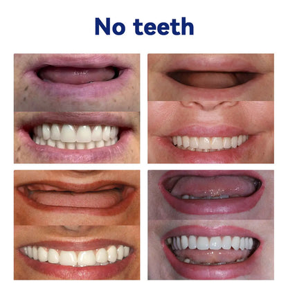 🦷Oveallgo™ 𝑆𝑖𝑙𝑖𝑐𝑜𝑛𝑒 𝐷𝑒𝑛𝑡𝑢𝑟𝑒 𝑅𝑢𝑙𝑒𝑟 𝑆𝑒𝑡