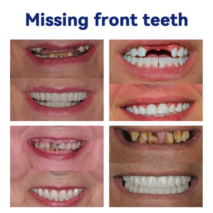 🦷Oveallgo™ 𝑆𝑖𝑙𝑖𝑐𝑜𝑛𝑒 𝐷𝑒𝑛𝑡𝑢𝑟𝑒 𝑅𝑢𝑙𝑒𝑟 𝑆𝑒𝑡