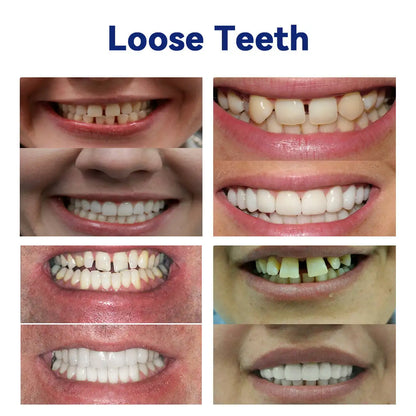 🦷Oveallgo™ 𝑆𝑖𝑙𝑖𝑐𝑜𝑛𝑒 𝐷𝑒𝑛𝑡𝑢𝑟𝑒 𝑅𝑢𝑙𝑒𝑟 𝑆𝑒𝑡